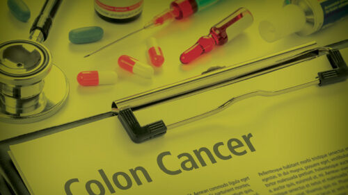 colorectal cancer